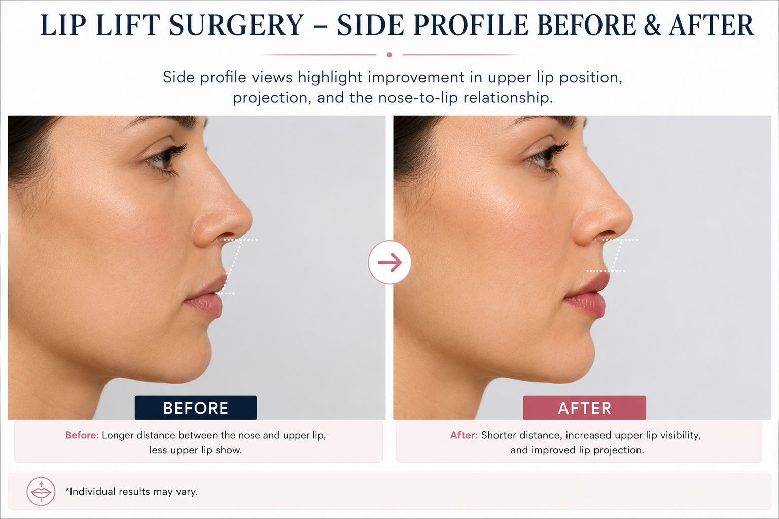 Lip Augmentation Surgery Before and After: Results, Recovery, Cost & Risks in 2026