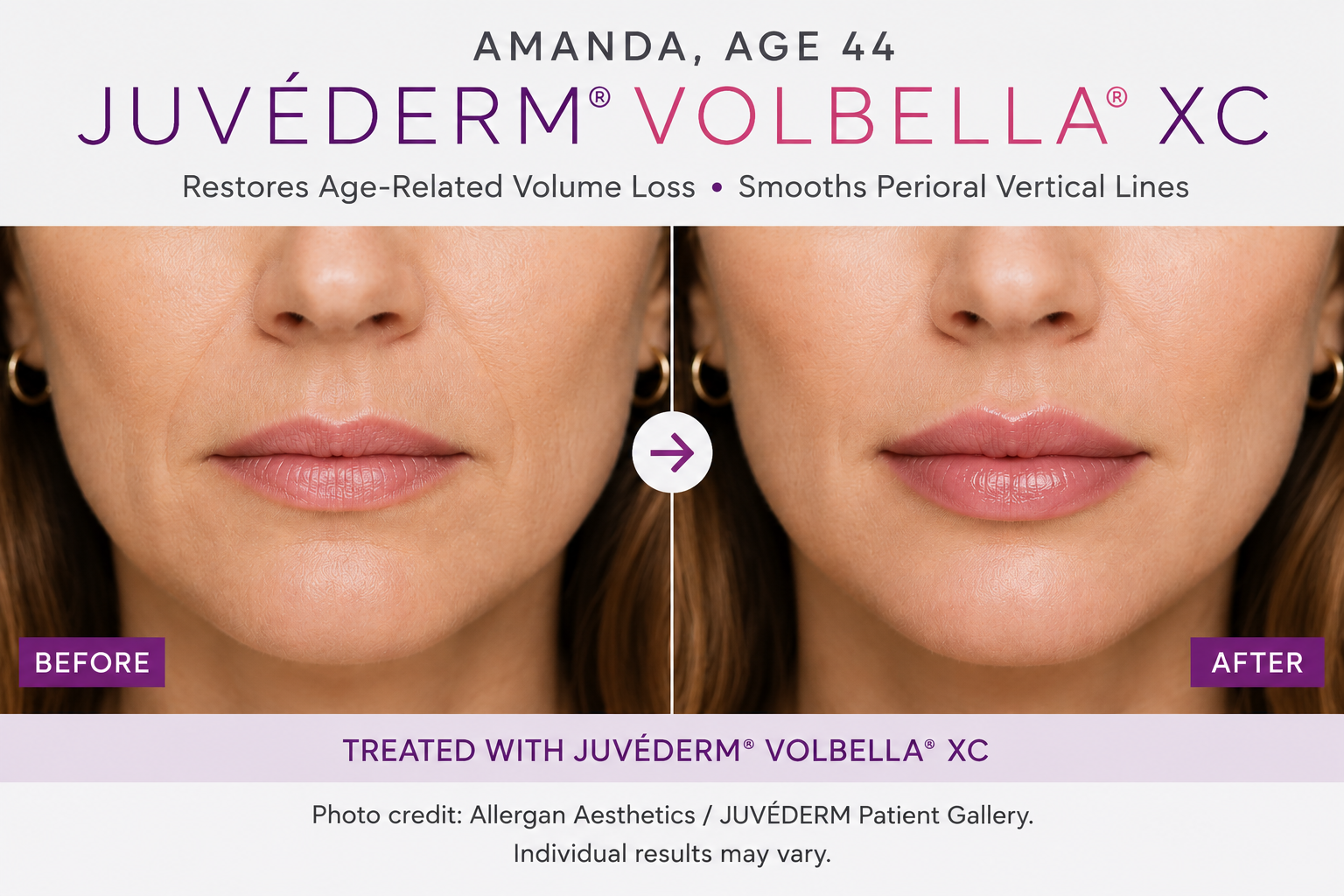 Amanda, Age 44 — JUVÉDERM VOLBELLA XC Lip and Perioral Line Correction Before and After