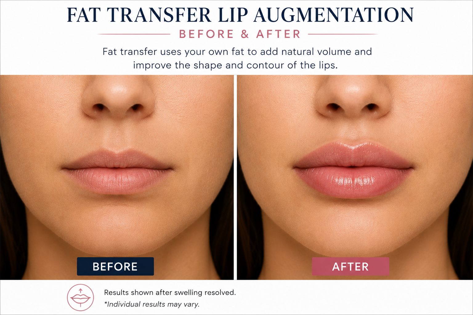 Lip Augmentation Surgery Before and After: Results, Recovery, Cost & Risks in 2026