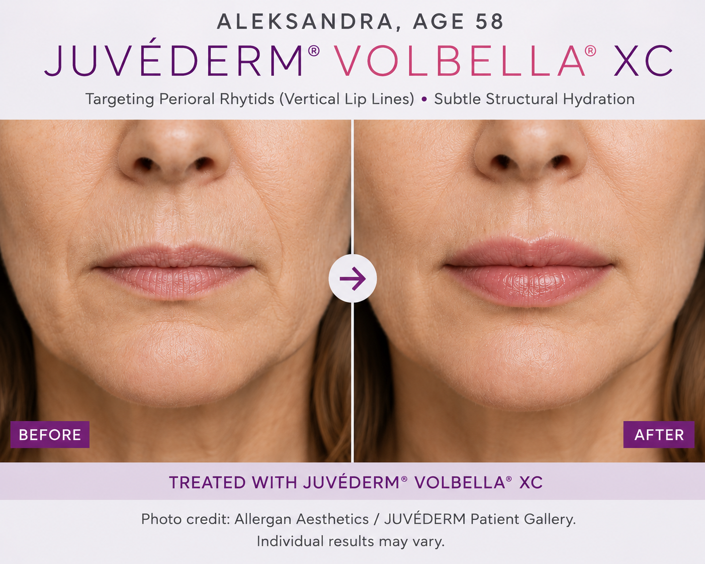 Aleksandra, Age 58 — JUVÉDERM VOLBELLA XC Lip Line Smoothing and Volume Before and After