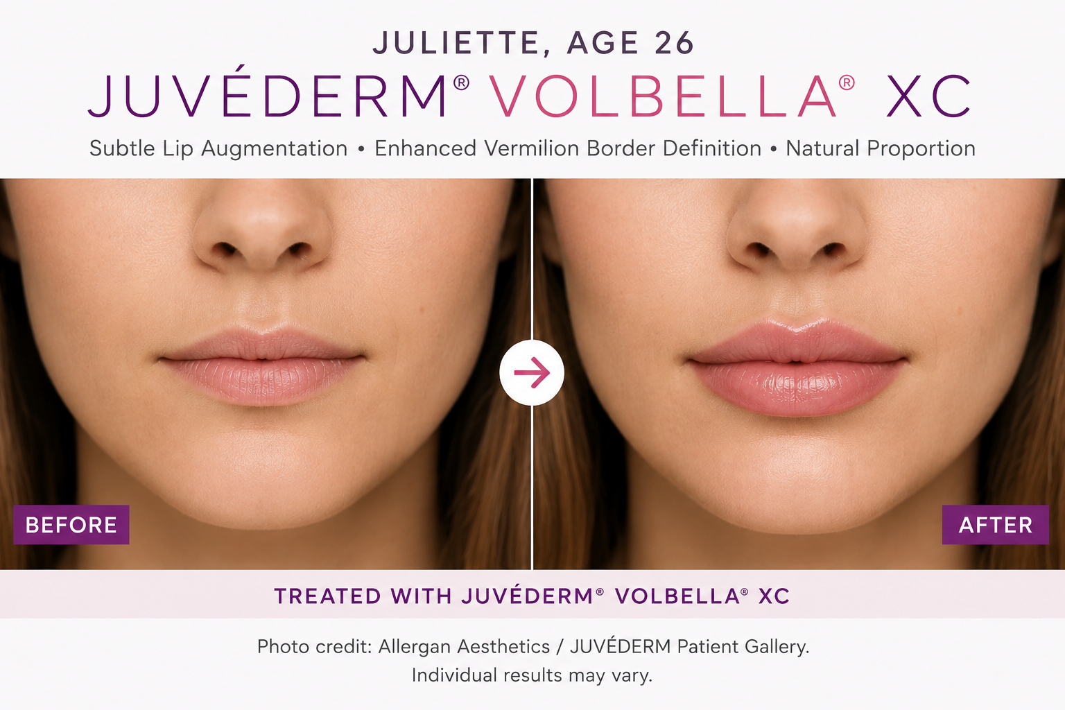Juliette, Age 26 — JUVÉDERM VOLBELLA XC Lip Filler Before and After Result