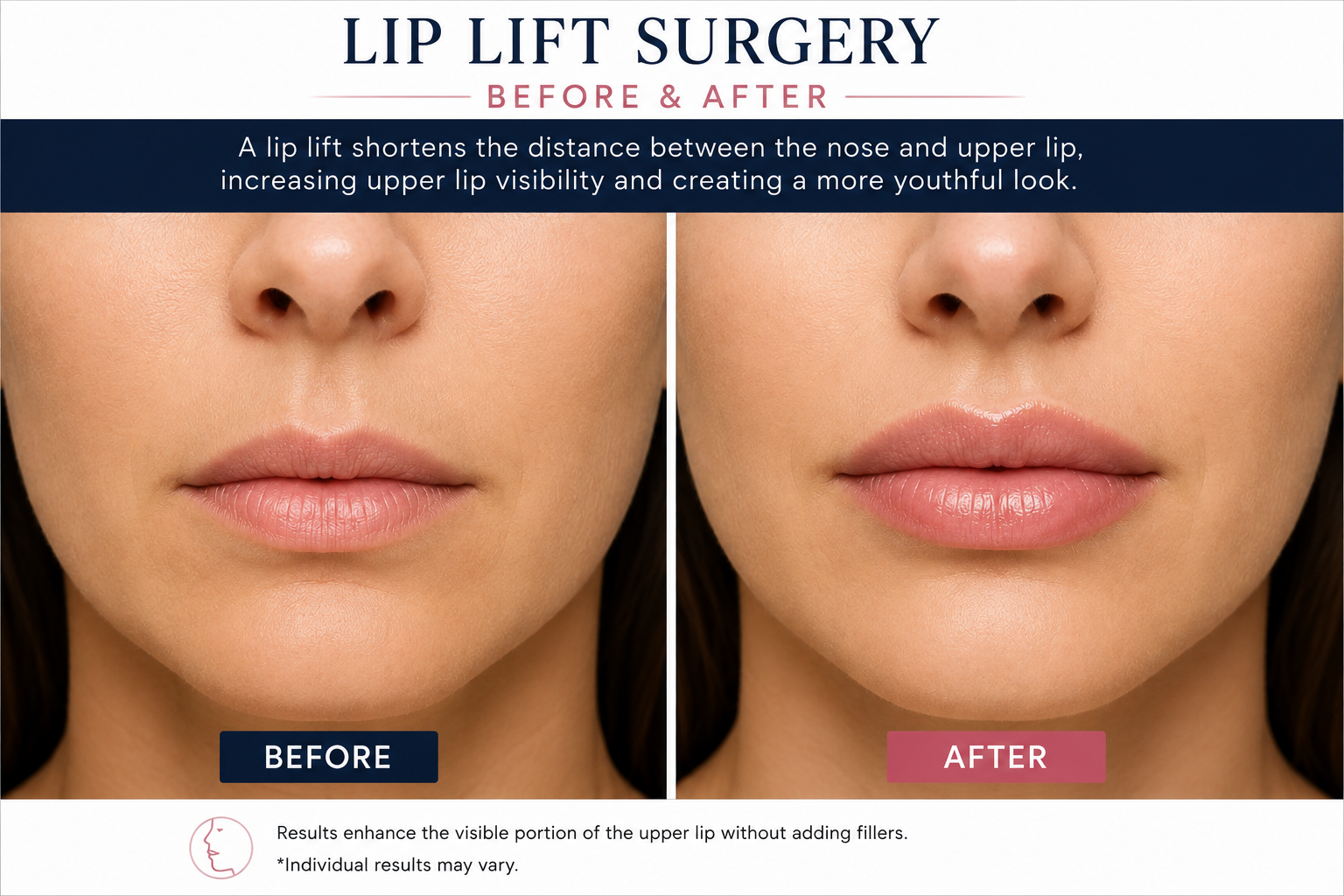 Lip Augmentation Surgery Before and After: Results, Recovery, Cost & Risks in 2026