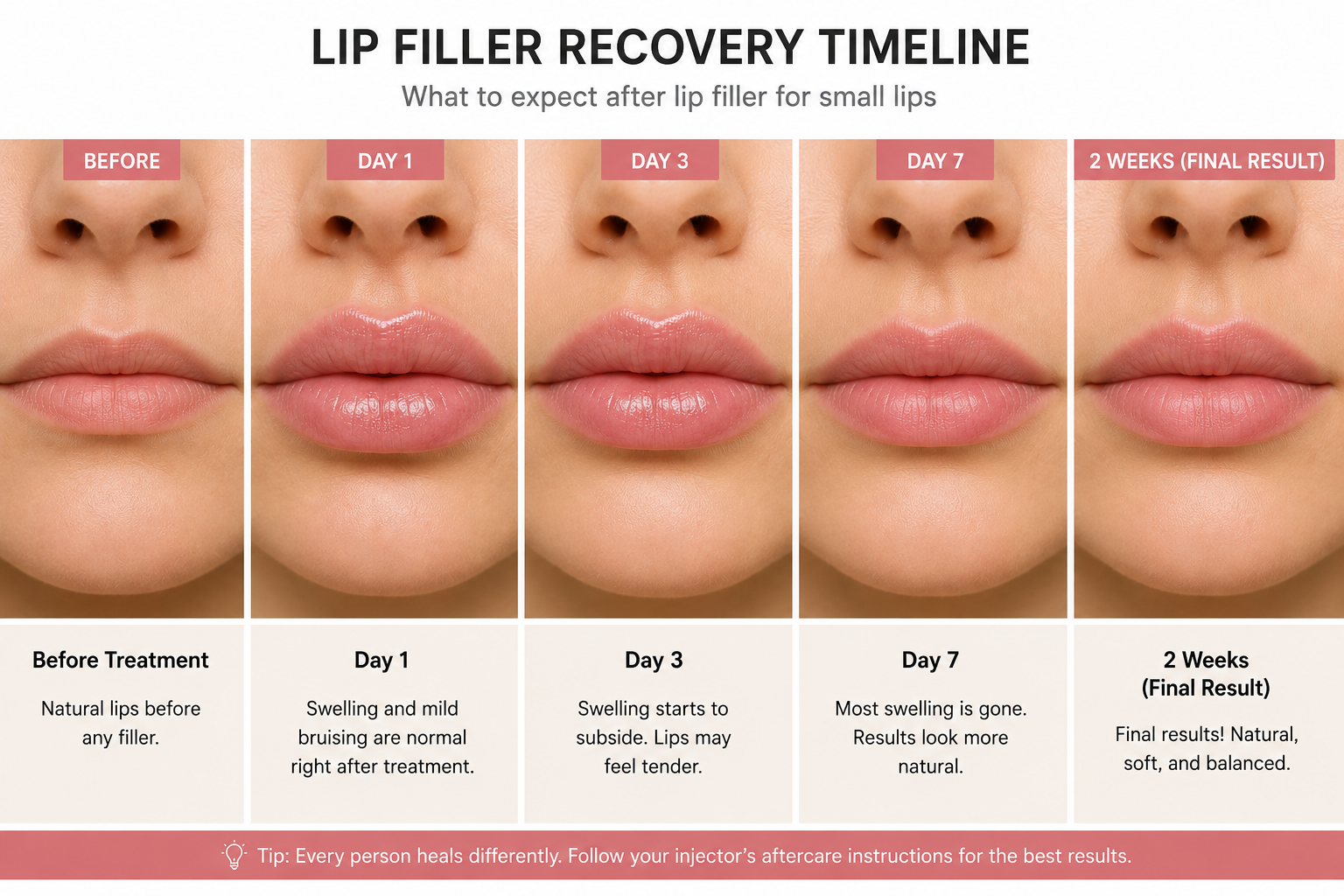 Lip filler recovery timeline showing how small lips may look before treatment and during the first two weeks of healing.